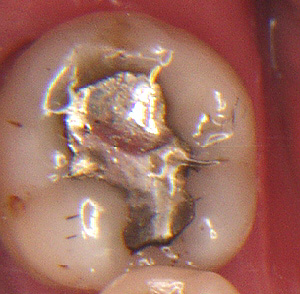 Silver/mercury dental amalgam
